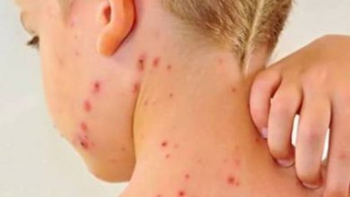 تقرير عالمى يكشف وفاة 140 ألف شخص العام الماضى بسبب الحصبة تقرير عالمى يكشف وفاة 140 ألف شخص العام الماضى بسبب الحصبة