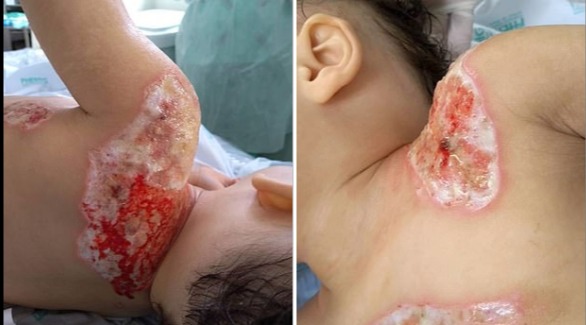 لاصق "سوبر غلو" يُحول جسد طفل إلى كتلة لهب لاصق "سوبر غلو" يُحول جسد طفل إلى كتلة لهب