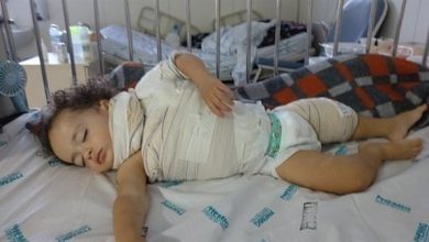 لاصق "سوبر غلو" يُحول جسد طفل إلى كتلة لهب لاصق "سوبر غلو" يُحول جسد طفل إلى كتلة لهب