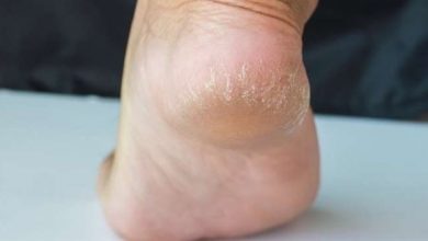 علاجات طبيعية لتشقق الكعبين علاجات طبيعية لتشقق الكعبين