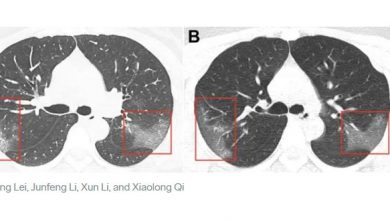 هكذا يصبح شكل رئة مصاب كورونا.. أعراض المرض هكذا يصبح شكل رئة مصاب كورونا.. أعراض المرض