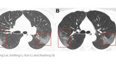 هكذا يصبح شكل رئة مصاب كورونا.. أعراض المرض هكذا يصبح شكل رئة مصاب كورونا.. أعراض المرض