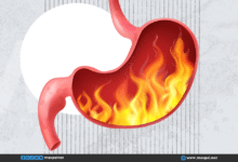 حرقة المعدة: أسبابها وأفضل الطرق لتخفيفها والوقاية منها حرقة المعدة: أسبابها وأفضل الطرق لتخفيفها والوقاية منها